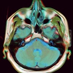 Mathematical Modeling Gains Days for Brain Cancer Patients